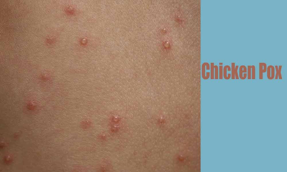 Chicken Pox and Homeopathy