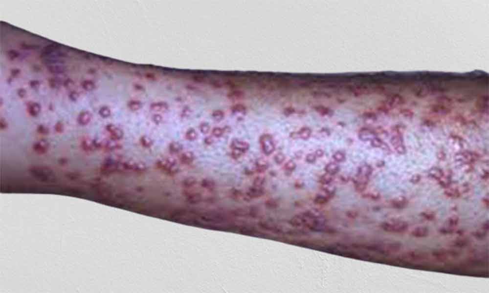 Small Pox and Homeopathy