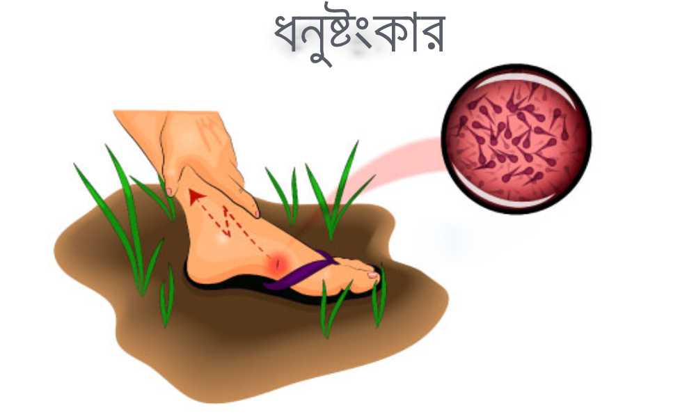 Treatment of Dhanushtankar disease